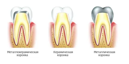 Коронки на зуби які краще, ціна, вартість установки на один зуб, які ставити на жувальні (коронки на зуби які краще ціна) Коронки на зуби які краще, ціна, вартість установки на один зуб, які ставити на жувальні