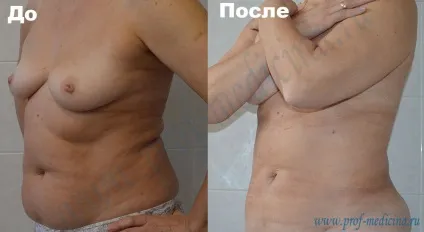 Корекція фігури за допомогою rf-ліпосакції body-tite (боді тайт)
