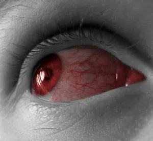 Червоні судини в очах причини, як позбутися, лікування (очах) Червоні судини в очах причини, як позбутися, лікування