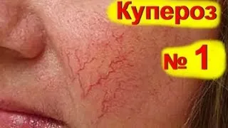 Крем від купероза на обличчі відгуки (купероза) Крем від купероза на обличчі відгуки