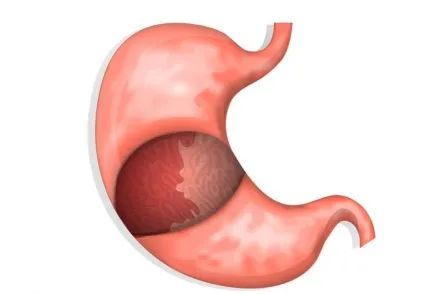 Кровотеча при виразці шлунка і дванадцятипалої кишки симптоми і лікування (виразці) Кровотеча при виразці шлунка і дванадцятипалої кишки симптоми і лікування