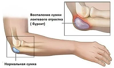 Лікування бурситу ліктьового суглоба народними засобами (бурситу) Лікування бурситу ліктьового суглоба народними засобами