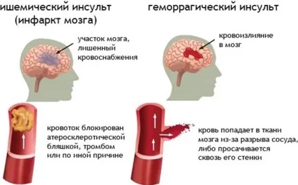 Лікування ішемічного інсульту вибір ефективних лікарських препаратів (ішемічного) Лікування ішемічного інсульту вибір ефективних лікарських препаратів