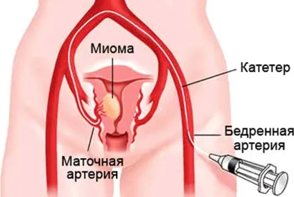 Лікування міоми народними засобами і традиційно (міоми) Лікування міоми народними засобами і традиційно
