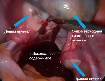 Лікування і причини появи Параоваріальні кісти яєчника (появи) Лікування і причини появи Параоваріальні кісти яєчника