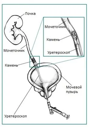 Літотрипсія каменів нирок, дроблення каменів в нирках і сечоводі (нирок) Літотрипсія каменів нирок, дроблення каменів в нирках і сечоводі
