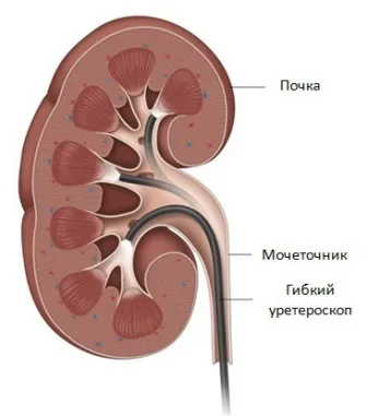 Літотрипсія каменів нирок, дроблення каменів в нирках і сечоводі (нирок) Літотрипсія каменів нирок, дроблення каменів в нирках і сечоводі