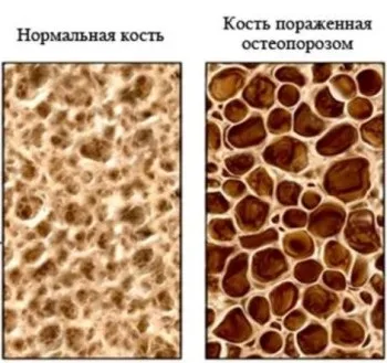 Лікування остеопорозу в домашніх умовах