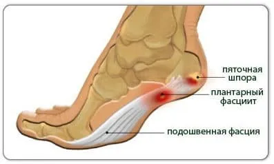 Лікування шпор на п'ятах медикаментозне і народне (народне) Лікування шпор на п'ятах медикаментозне і народне