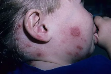 Лишай на мові червоний, плоский, причини появи, способи лікування (плоский) Лишай на мові червоний, плоский, причини появи, способи лікування