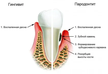 Лікування запалення ясен - способи лікування гінгівіту і пародонтиту (ясен) Лікування запалення ясен - способи лікування гінгівіту і пародонтиту