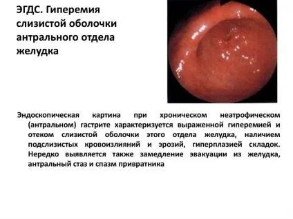Лімфоїдна гіперплазія антрального відділу слизової шлунка (слизової) Лімфоїдна гіперплазія антрального відділу слизової шлунка