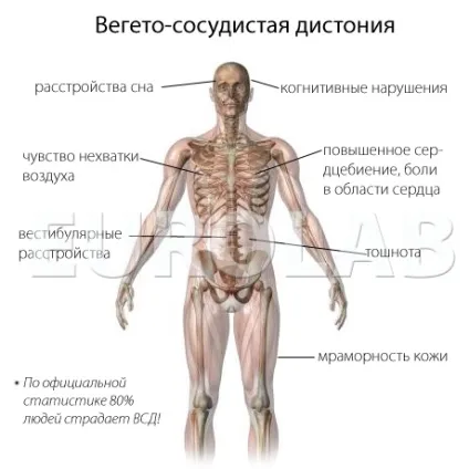 Лікування вегето-судинної дистонії - медичний портал eurolab (вегето-судинної) Лікування вегето-судинної дистонії - медичний портал eurolab