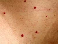 Маленькі червоні точки на тілі від чого з'являються і що означають (маленькі) Маленькі червоні точки на тілі від чого з'являються і що означають