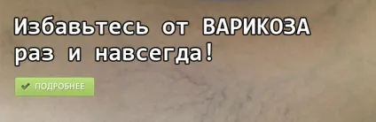 Медикаментозне лікування тромбофлебіту нижніх кінцівок, лікування варикозу (лікування) Медикаментозне лікування тромбофлебіту нижніх кінцівок, лікування варикозу
