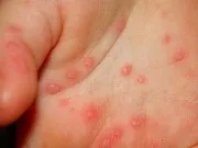 мікотіческая екзема