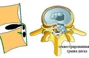 Чи можна вилікувати секвеструвати грижу без операції (вилікувати) Чи можна вилікувати секвеструвати грижу без операції