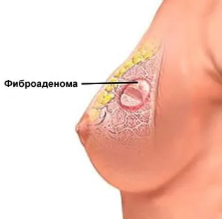 Молочна залоза, її функції, будова і захворювання (захворювання) Молочна залоза, її функції, будова і захворювання