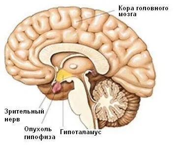 Мрт аденоми гіпофіза