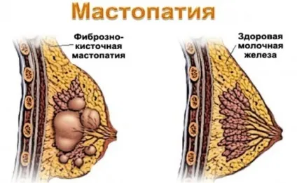 Молочна залоза, її функції, будова і захворювання (молочна) Молочна залоза, її функції, будова і захворювання