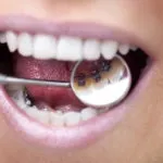 Ножицеподібний прикус у собак як відрізнити неправильний прикус (прикус собак фото) Ножицеподібний прикус у собак як відрізнити неправильний прикус
