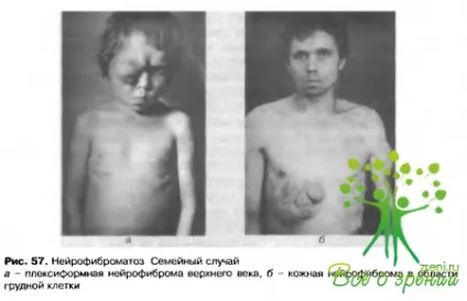 Новоутворення століття, захворювання повік (іноді) Новоутворення століття, захворювання повік