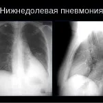 Особливості протікання пневмонії у дітей, її симптоми і види (особливо) Особливості протікання пневмонії у дітей, її симптоми і види