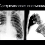 Особливості протікання пневмонії у дітей, її симптоми і види (дітей) Особливості протікання пневмонії у дітей, її симптоми і види