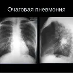 Особливості протікання пневмонії у дітей, її симптоми і види (пневмонії) Особливості протікання пневмонії у дітей, її симптоми і види