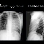 Особливості протікання пневмонії у дітей, її симптоми і види (здоров'я дитини) Особливості протікання пневмонії у дітей, її симптоми і види