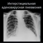 Особливості протікання пневмонії у дітей, її симптоми і види (пневмонії) Особливості протікання пневмонії у дітей, її симптоми і види