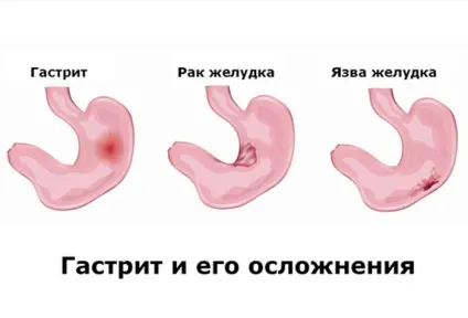 Ускладнення, наслідки та проблеми гастриту (гастриту) Ускладнення, наслідки та проблеми гастриту