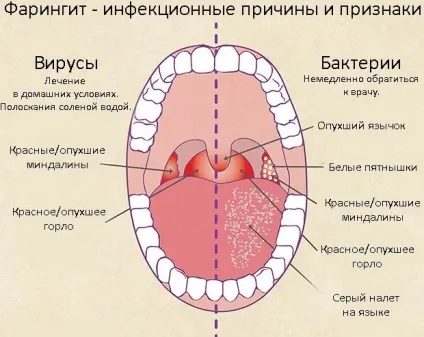 Гострий і хронічний фарингіт у дітей і дорослих симптоми і лікування, фото (фарингіт лікування народними) Гострий і хронічний фарингіт у дітей і дорослих симптоми і лікування, фото