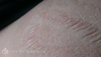 Опік йодом що робити