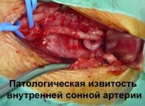 Патологічна звивистість внутрішньої сонної артерії (внутрішньої) Патологічна звивистість внутрішньої сонної артерії