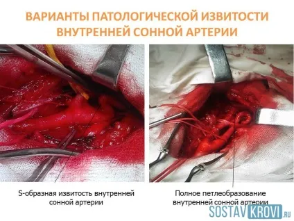 Патологічна звивистість судин головного мозку, шиї, хребетних і сонних артерій, причини, (патологічна) Патологічна звивистість судин головного мозку, шиї, хребетних і сонних артерій, причини,