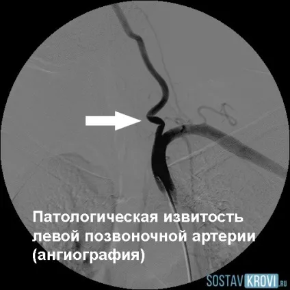 Патологічна звивистість судин головного мозку, шиї, хребетних і сонних артерій, причини, (судин) Патологічна звивистість судин головного мозку, шиї, хребетних і сонних артерій, причини,