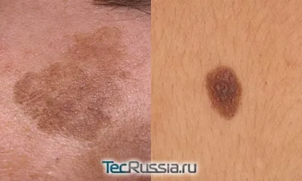 Пігментні плями на тілі (плями) Пігментні плями на тілі