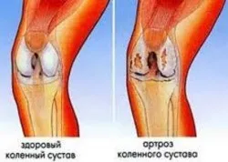 Чому болять суглоби і хребет список хвороб (суглоби) Чому болять суглоби і хребет список хвороб