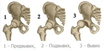 Подушка Фрейка форма - дисплазія невідкладні заходи (стегна відносно кульшової) Подушка Фрейка форма - дисплазія невідкладні заходи
