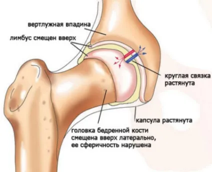 Подушка Фрейка форма - дисплазія невідкладні заходи (стегна відносно кульшової) Подушка Фрейка форма - дисплазія невідкладні заходи