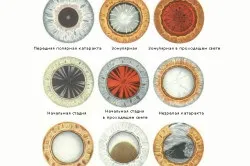 Помутніння кришталика причини, симптоми, лікування катаракти (фото)