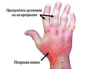Поліартрит - симптоми і лікування захворювань суглобів