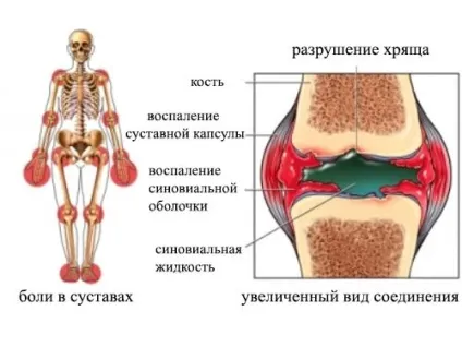 Поліартрит - симптоми і лікування захворювань суглобів