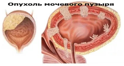 Наслідки та відгуки видалення сечового міхура у чоловіків (відгуки) Наслідки та відгуки видалення сечового міхура у чоловіків