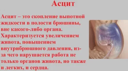 Наслідки та відгуки видалення сечового міхура у чоловіків (наслідки) Наслідки та відгуки видалення сечового міхура у чоловіків