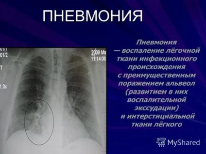Після пневмонії як довго відновлюється організм реабілітація після хвороби у дорослих і дітей (реабілітація) Після пневмонії як довго відновлюється організм реабілітація після хвороби у дорослих і дітей