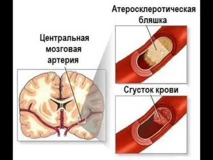 Повторний інсульт прогноз, наслідки і скільки живуть люди (живуть) Повторний інсульт прогноз, наслідки і скільки живуть люди