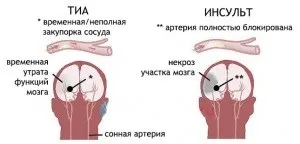 Минуще порушення мозкового кровообігу симптоми і лікування (минуще) Минуще порушення мозкового кровообігу симптоми і лікування