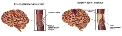 Препарати і ліки для судин головного мозку нового покоління
